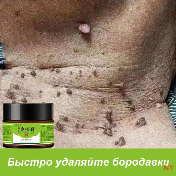 Крем для удаления бородавок и родинок 20g от папиллом и бородавок на ...