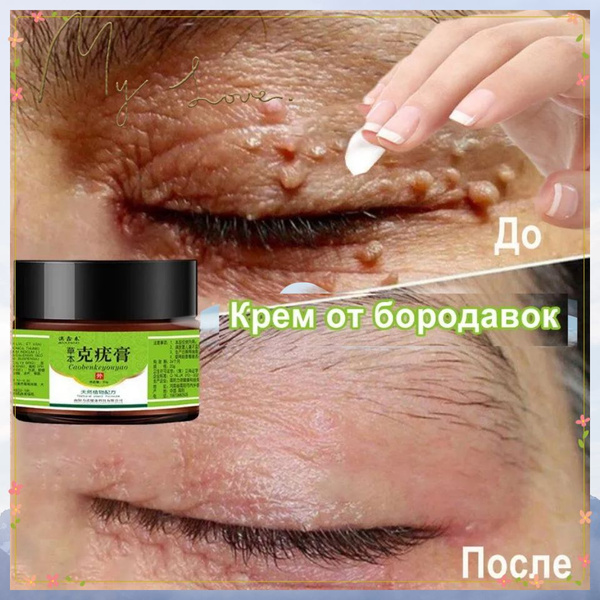 Вопросы и ответы о Крем для удаления бородавок и родинок 20g от ...