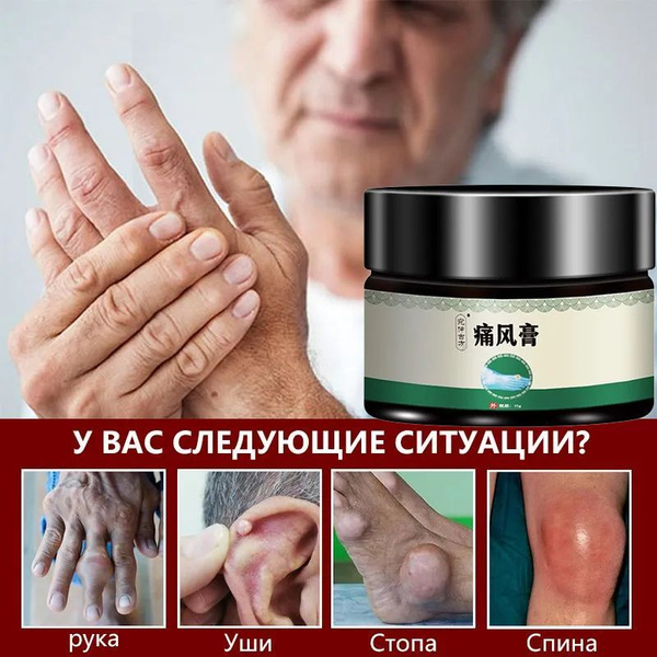 Мазь от подагры, лечение артрита, шейного спондилеза, облегчение ...