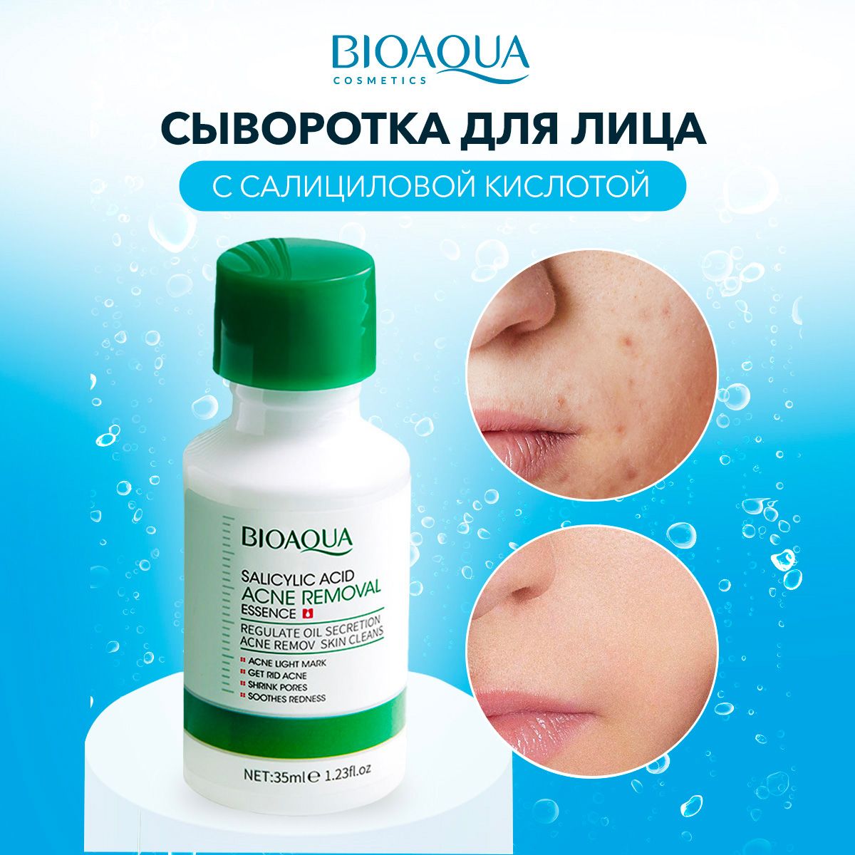 Сывороткадлялицаотпрыщейувлажняющаяссалициловойкислотой/Bioaqua