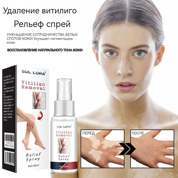 SOL LORA Спрей для облегчения удаления витилиго Спрей для ...