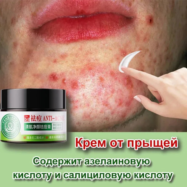 Крем от прыщей и акне точечного действия, 90 г, для проблемной кожи ...