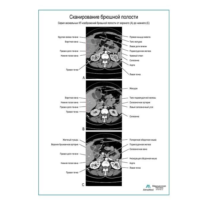 томограмма брюшной полости кт. сканирование брюшной полости. бляшка в брюшной полости. кт брюшной полости поперечный срез. магнитно-резонансную томографию поджелудочной железы.