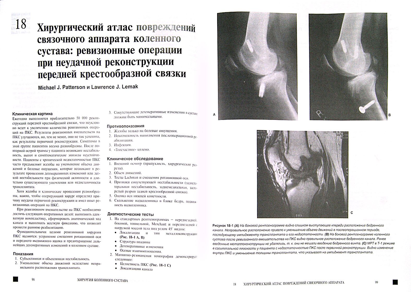Порванные крестообразные связки. Степень нестабильности коленного сустава классификация. Степень нестабильности коленного сустава классификация. Субтотальный разрыв пкс. Коленный сустав оперативная хирургия.