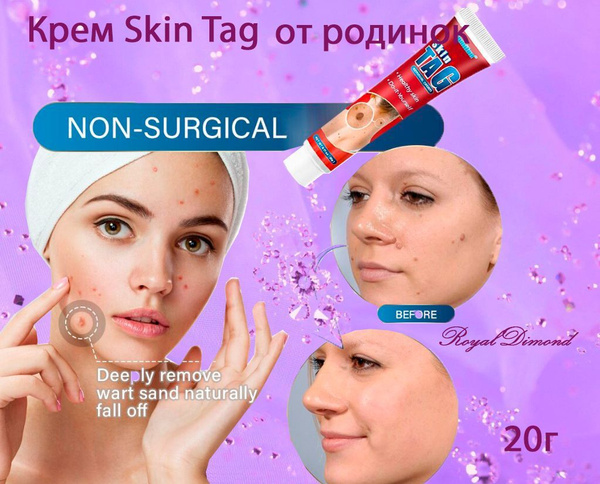 Мазь от родинок, Skin tag - купить с доставкой по выгодным ценам в ...