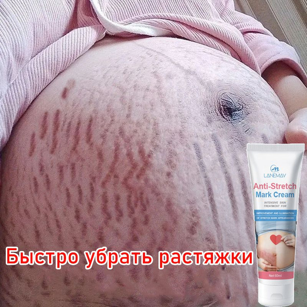 Крем от растяжек для тела при беременности 60 мл Быстрое удаление ...