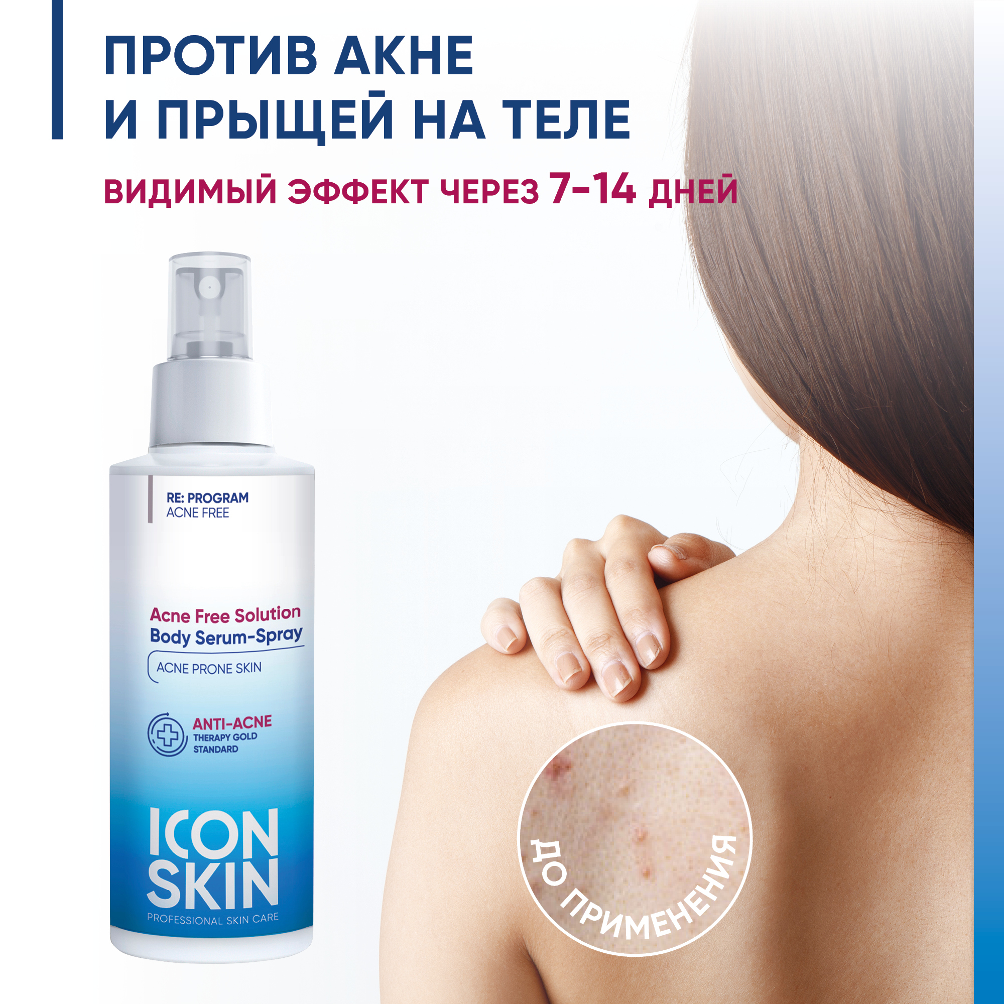 Icon skin производитель. Айкон скин анти акне. Icon Skin сыворотка. Айкон скин сыворотка от прыщей. Гель для душа от прыщей на спине.