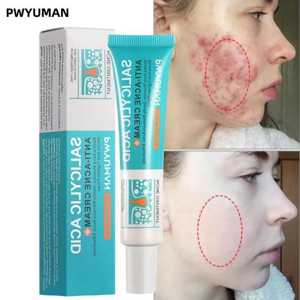 PWYUMAN/салициловая кислота лечение угорь прыщ Мазь 30g - купить с ...