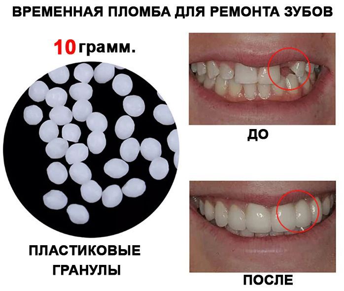 Установка зубной пломбы – низкие цены в Бутово