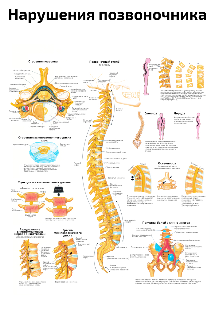 Плакат обучающий А2 ламинир. Нарушения позвоночника: медицинский и анатомический постер 457x610 мм
