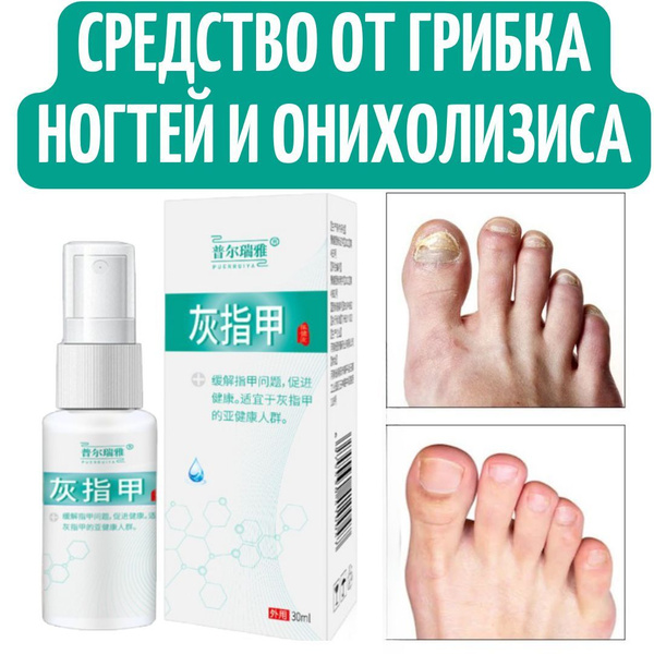 Средство от грибка ногтей на ногах. Эффективное лечение онихолизиса ...