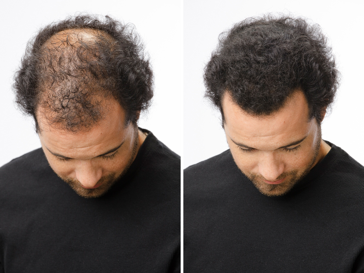 Волос стал виться. Загуститель для волос Caboki Dexe hair building Fibers. Загуститель бороды Toppik. Выпадение волос у мужчин.