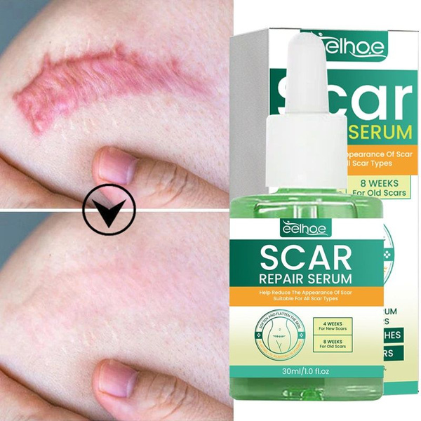 Сыворотка для удаления шрамов после прыщей, лечения пятен от прыщей ...