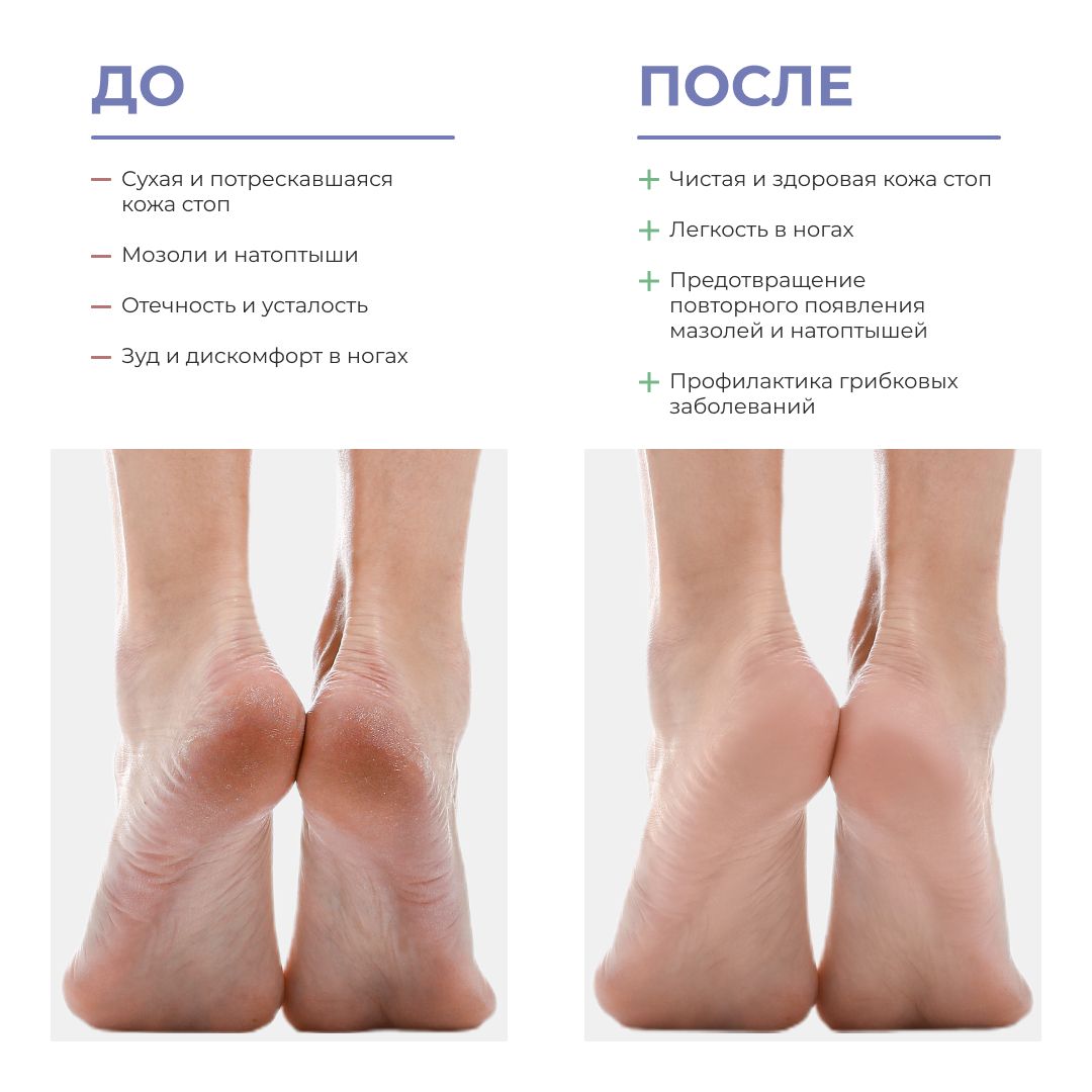 Крем от сухих пяток и трещин. Увлажняющий крем для пяток. Крем для ног трещины на пятках. Крем для ног от трещин на пятках и сухости. Аппликации кератолитиком в педикюре.