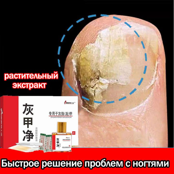 Средство от грибка ногтей на ногах,профилактика и лечение от грибка ...