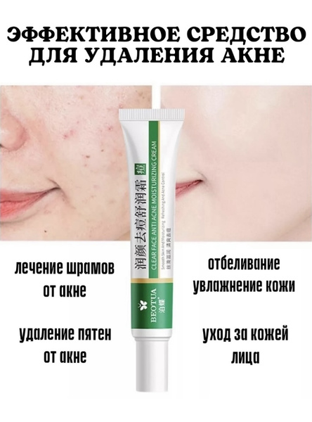 Крем для лечения акне угрей/От прыщей для проблемной кожи лица угревой ...
