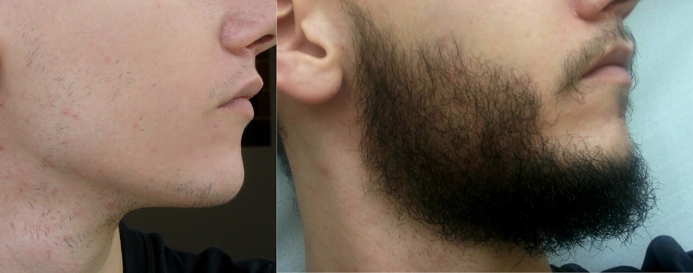 Что отвечает за рост волос на лице у мужчин