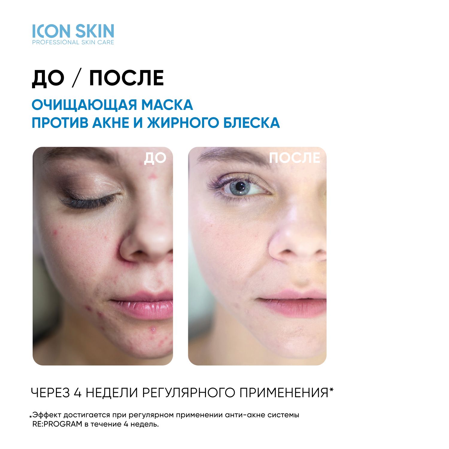 Aravia anti acne peeling. Therapy vitrio anti-acne. пилинги для проблемной кожи отзывы. аравия энзимная пудра с азелаиновой кислотой. азелаиновый пилинг для лица.
