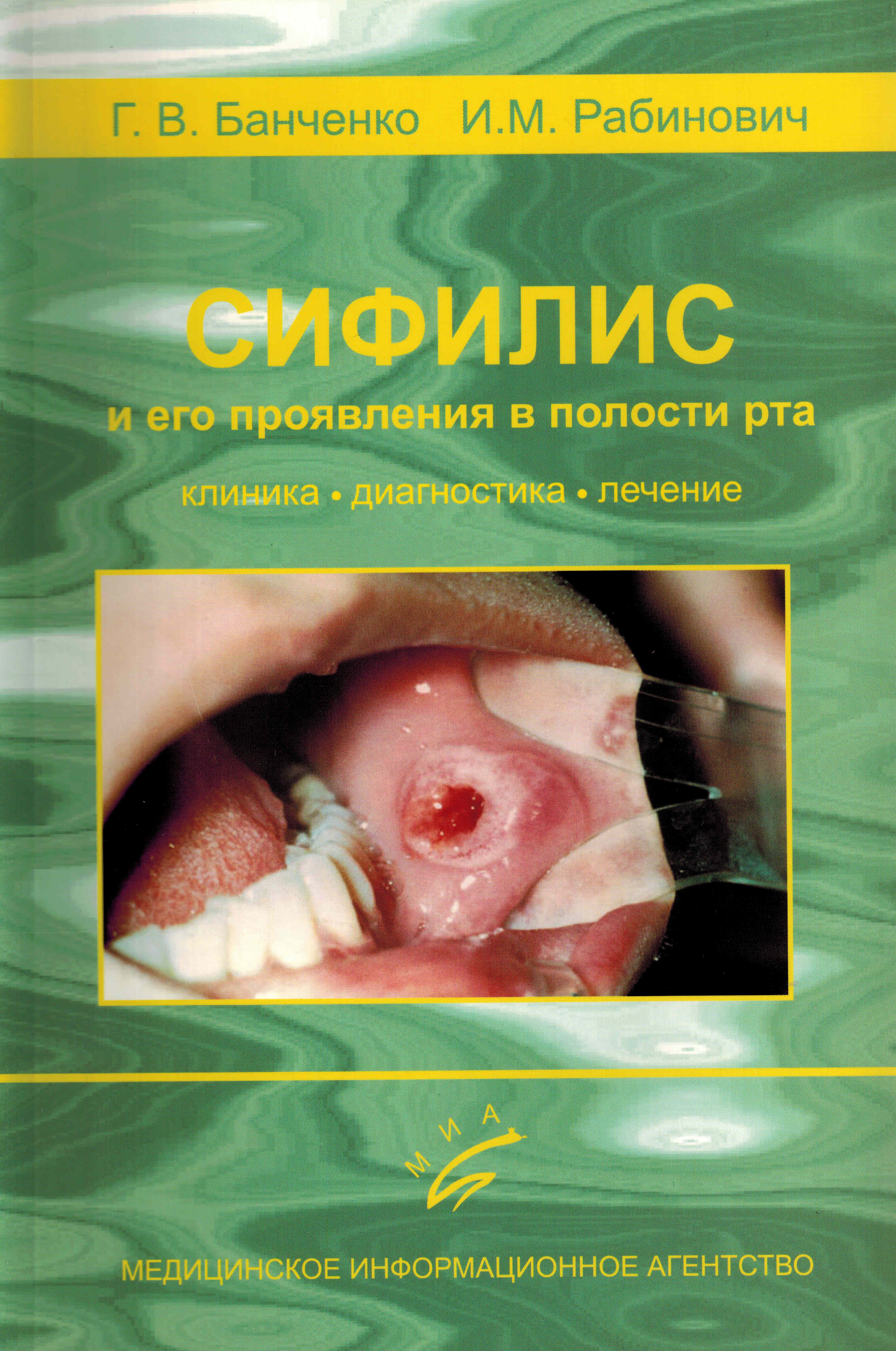Сифилис во рту - фото инфекции в ротовой полости человека