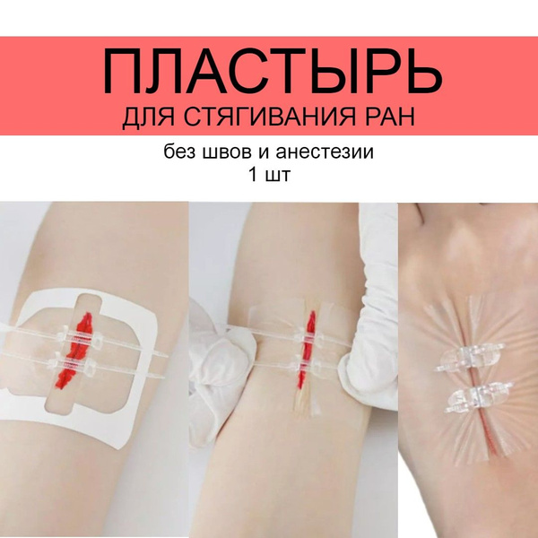Чем можно заменить пластырь в домашних условиях Лейкопластырь Пластырь для стягивания ран / Пластырь для стяжки ран / Без шрамов