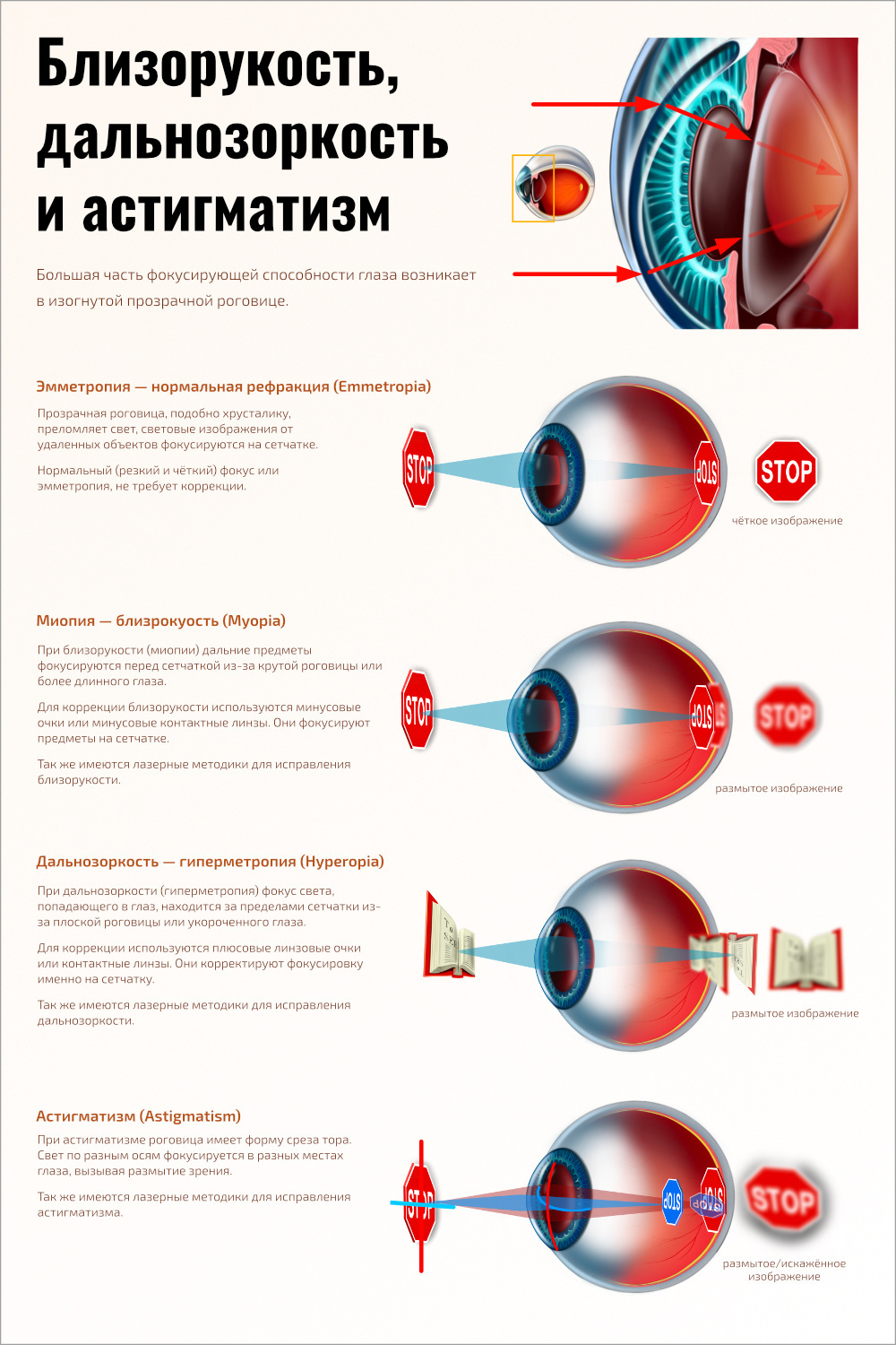Близорукость и дальнозоркость. Астигматизм и близорукость. Наглядные пособия по офтальмологии. Близорукость плакат. Плакаты по офтальмологии.