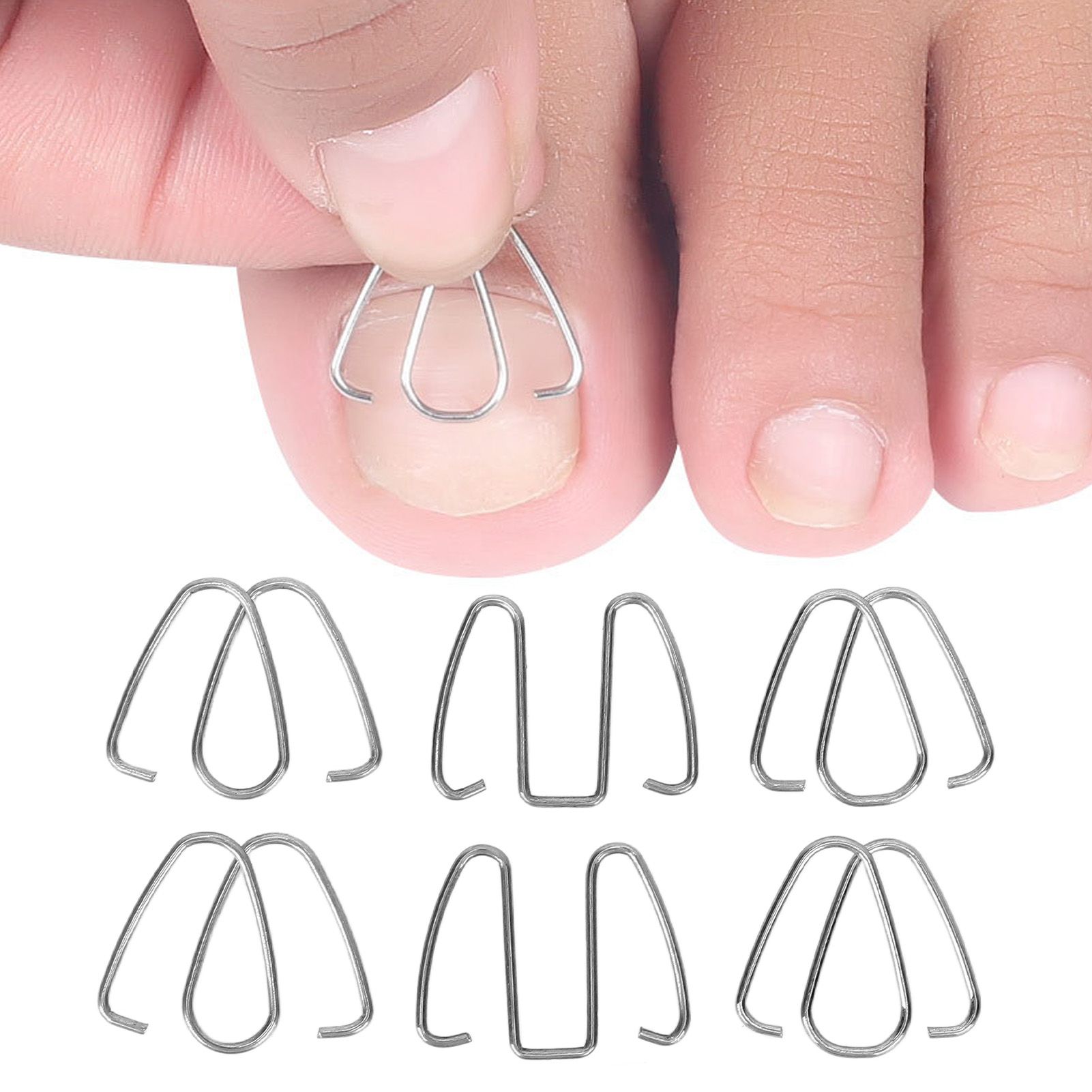 Фиксатор проволоки для вросших ногтей