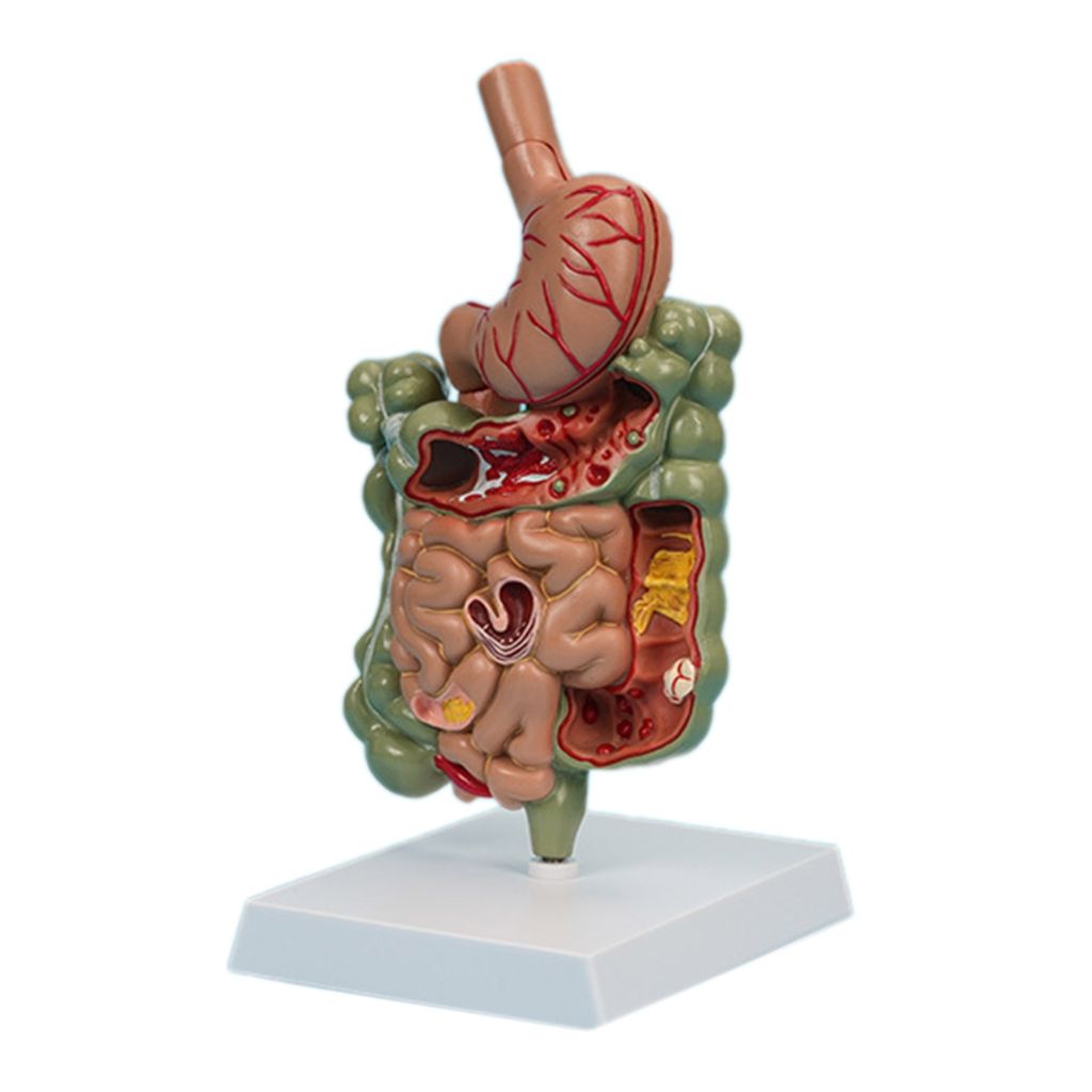 Модель патологической анатомии желудочно-кишечного тракта для изучения заболеваний, медицинские учебные пособия по пищеварительной системы