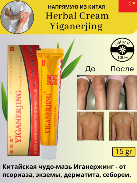 Крем от кожных заболеваний Иганержинг (Yiganerjing Herbal Cream) чудо ...