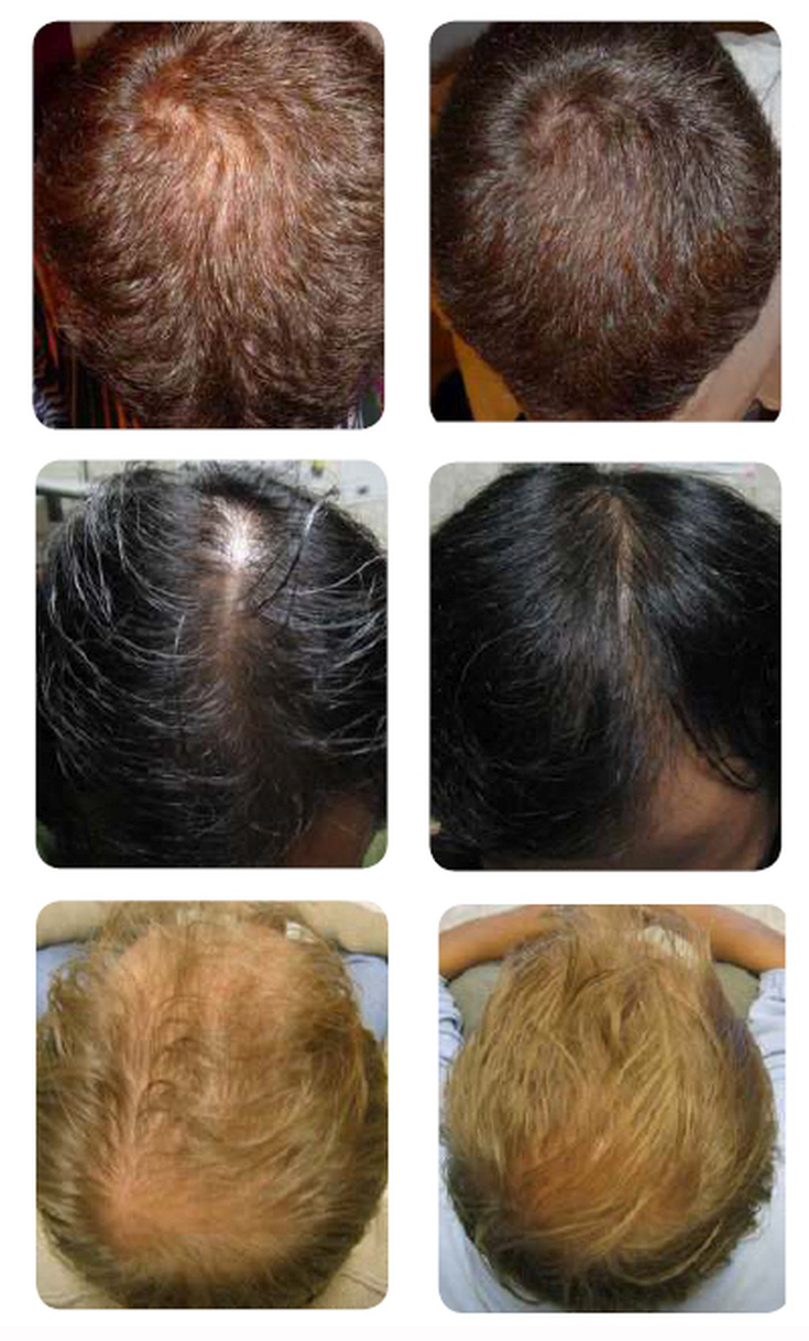 После приема выпадают волосы. Эсвицин андрогенная алопеция. Эсвицин до и после. Эсвицин на облысение.