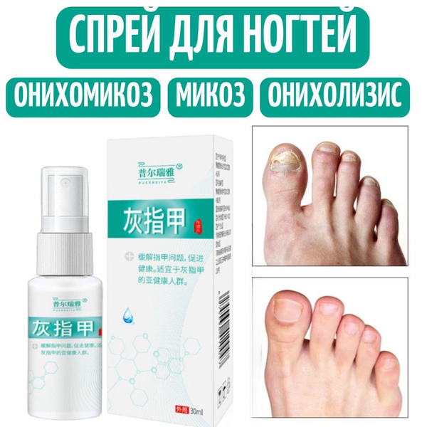 Средство от грибка ногтей на ногах для лечения онихолизиса, онихомикоза ...