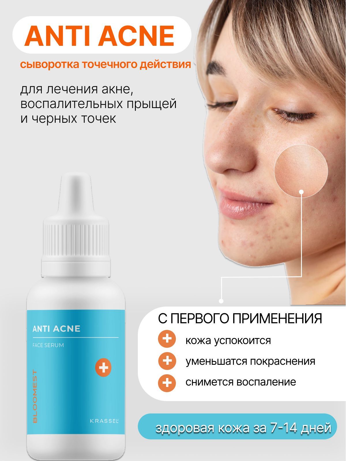 Крем сыворотка ANTI ACNE точечного действия для лечения акне, от  воспалительных прыщей и ухода за кожей постакне. 30 мл. - купить с  доставкой по выгодным ценам в интернет-магазине OZON (1227622301)