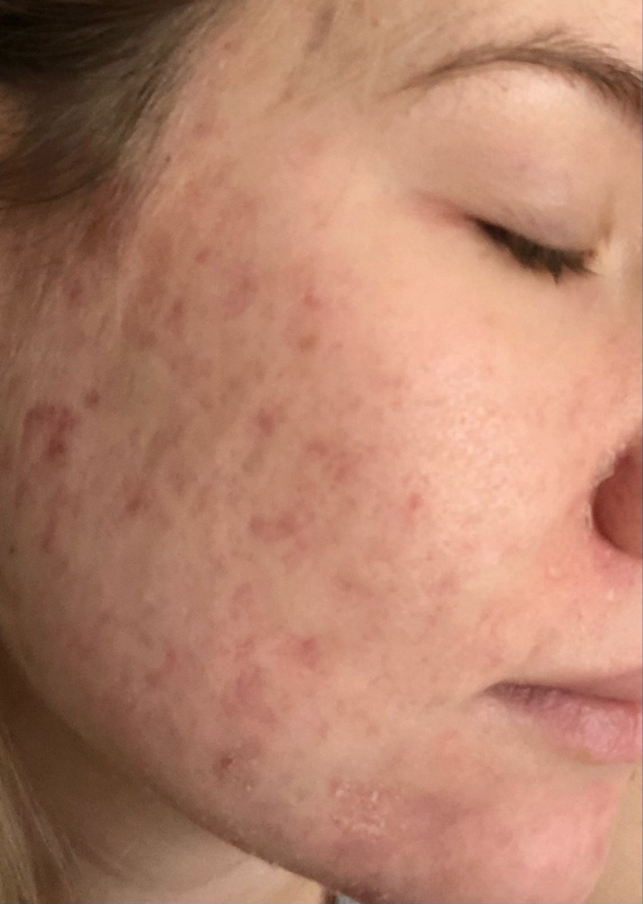 BTpeel Азелаиновый пилинг Azelaic Peel 20%, 10 мл — купить в интернет ...