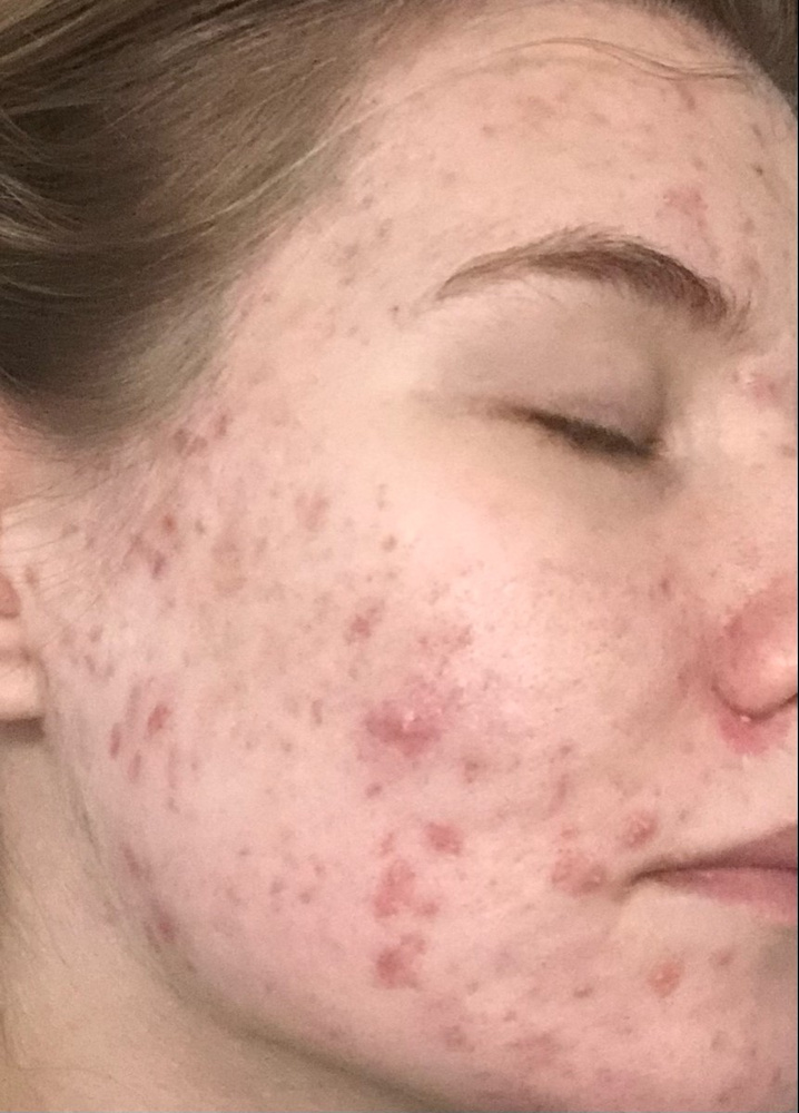 BTpeel Азелаиновый пилинг Azelaic Peel 20%, 10 мл — купить в интернет ...