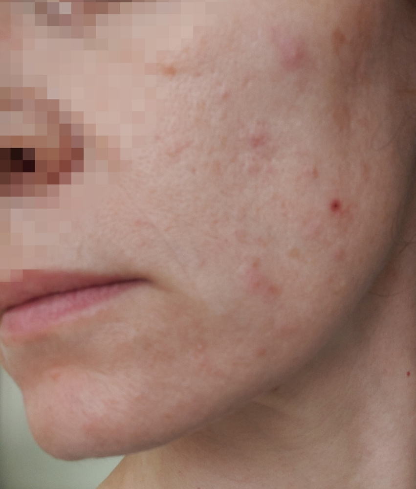 BTpeeL Гликолевый пилинг 10% с ДМАЕ и матриксилом, 10 мл - купить с ...