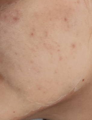 BTpeeL Гликолевый пилинг 10% с ДМАЕ и матриксилом, 10 мл - купить с ...
